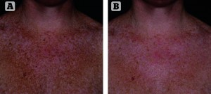 Figure 1 Improvement in appearance of photodamage to the décolletage using cosmeceutical formulations (Obagi Medical), (A) before and (B) 8 weeks post-treatment