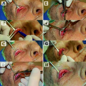Figure 1 The Müller muscle–conjunctival resection. (A) The superior border of the tarsus is outlined with a marking pen, (B) calipers are used to measure the amount of tissue excision desired above the superior tarsus, (C) this is marked on the conjunctiva, (D) a mullerectomy clamp is then placed to encompass the demarcated tissue consisting of Müller muscle and conjunctiva, (E) a size 6-0 double armed plain suture is then run along the underside of the clamp starting at the temporal edge, (F) when the medial edge has been reached, a number 15 blade is used to make an incision along the underside of the clamp, (G) the suture is then run from the medial to temporal, hooking the conjunctiva and Müller muscle to the superior edge of the tarsus, (H) the two ends of the suture at the temporal edge are passed through the wound so that the knot will be buried when the suture is tied
