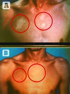 Figure 1 32-year-old male patient who had suffered from vitiligo for 10 years. (A) Before and (B) after 1 year of treatment