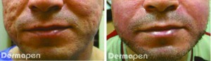 Figure 1 (left) Before and (right) after six Dermapen treatments spaced 6 weeks apart