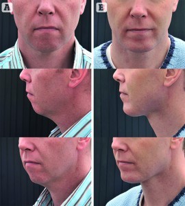 Figure 3 Cervicoplasty and chin augmentation with implant, (A) before and (B) 6 months post-surgery 