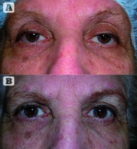 Figure 2 Patient (A) before and (B) after procedure