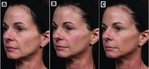(A) Before treatment with Thermage Total Tip,  (B) immediately post‑treatment, and  (C) 2 months post-treatment