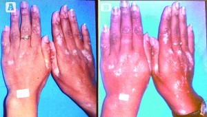 Figure 2 18-year-old female patient who had suffered from vitiligo for 3 years. (A) Before and (B) results after 2 weeks of treatment
