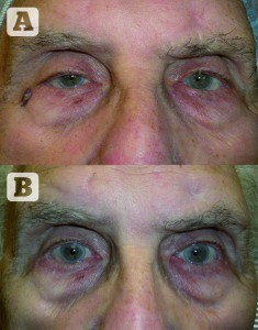 Figure 3 Patient (A) before and (B) after procedure 