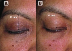 Figure 3 (A) Before and (B) 30 days after one treatment with Pellevé