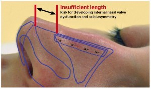 Figure 4 Indications for traditional spreader grafts, or combination procedures