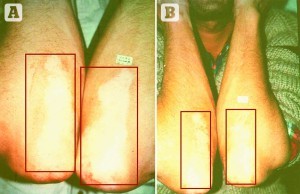 Figure 4  34-year-old male patient who had suffered from vitiligo for 6 years. (A) Before and (B)results after 3 months of treatment 