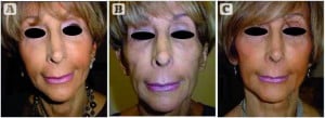 Figure 1 (A) 60-year-old patient before bilateral facial lipostructure with platelet-rich fibrin, (B) 2 months after treatment, and (C) 8 months postoperatively
