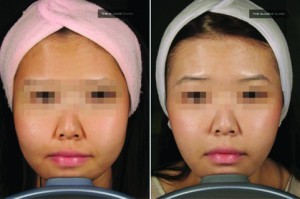 Figure 2 Neurotoxin treatment of masseters can lead to a tapering of the lower facial shape.