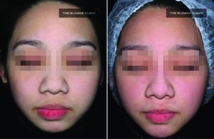 Figure 3 Augmentation of the chin with dermal fillers to improve mandibular contour and projection.
