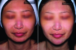 Figure 4 Augmentation of the chin using dermal fillers to achieve a V-shape face