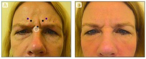 Figure 1 Treatment to the glabella with botulinum toxin A, (A) before treatment and (B) 3 weeks after treatment. Procerus received 4 U; corrugator supercilii and depressor supercilii received medial 4 U medially and 2 U each laterally (16 U total)