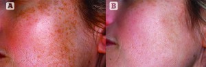 Figure 1 Phototype III, 39-year-old female patient with melasma that manifests as small spots all over the cheeks (A), and which was resistant to topical depigmenting treatment. Alternative treatment was performed using FT pulsed light with 520 nm filter, 14 J energy and 2-pulses emission with Ton: 5, and repeated twice with a 1-month interval (B). Maintenance treatment comprises one session during winter to correct summer damage