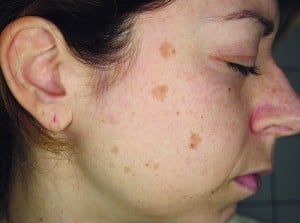 Figure 1 Pigmented blotches on the right side of the face