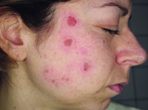Figure 2 Typical erythema immediately after a session of Q-switched Nd:YAG laser (Duolite QS; DEKA Laser, Florence, Italy)