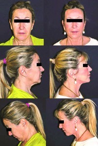 Figure 2 (A), (B) and (C) Preoperative photos of a 59-year-old woman requesting facial rejuvenation, and (D), (E), and (F) postoperative photos after face-lift assisted by stromal enriched lipograft