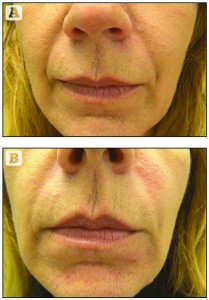 Figure 4 Treatment to the nasolabial folds with dermal filler, (A) before treatment and (B) directly after treatment. This demonstrates the direct filling technique; linear threading with a short, sharp 27G needle, injecting Radiesse®, 0.5 cc per side, premixed with Lidocaine 1%