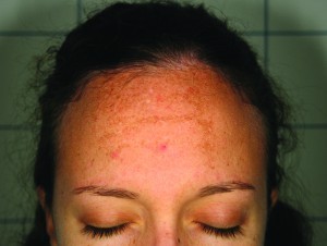 Figure 4 A patient with a facial melasma with the pigment almost along forehead wrinkles