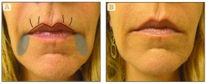 Figure 5 Treatment to the perioral region with dermal filler, (A) before treatment and (B) directly after treatment. Indirect filling technique to the upper lip; linear threading, 27 G blunt, 1.5-inch cannula, automated injection of Belotero Intense® 1 cc, premixed with Lidocaine 1%. Direct filling technique to the upper lip rhytides; linear threading with a sharp, short 30 G needle, Belotero soft® 0.5 cc. Corners of the mouth; linear threading and crosshatch, sharp, short 27 G needle, Belotero Intense® 1 cc