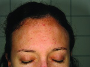 Figure 5 After three intense pulsed light (IPL) (Photosilk Plus, DEKA Laser, Florence, Italy) sessions and one session of the short-pulse alexandrite laser (Synchro Repla:Y, DEKA Laser, Florence, Italy) hyperpigmentation is reduced