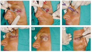 Figure 5 (A) Skin incision along the marked line. (B) Skin and orbicularis are undermined. (C) Skin-muscle flap draped upward and laterally. (D) Skin excision. (E) Nice fitting all along the skin incision without excess skin. (F) Supporting 6-0 prolene sutures. (G) Skin closed with interrupted sutures.