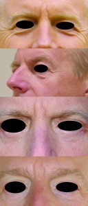 Figure 6 (A) and (B) before mini-lift blepharoplasty treatment. (C) 3 weeks postoperatively and (D) 3 years postoperatively