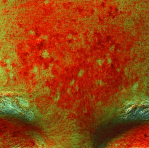 Figure 6  A multispectral evaluation of the melanin content of pigmented lesions