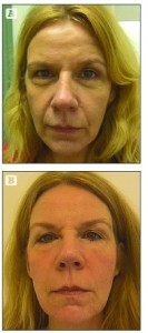 Figure 7 Before (2005) (A) and after (2012) (B) total treatment