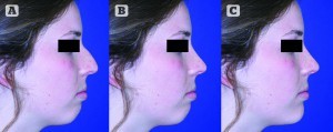 Figure 4 This series of images shows (A) preoperative appearance, (B) the potential benefit of a rhinoplasty alone, and (C) a rhinoplasty with a chin implant using computer imaging