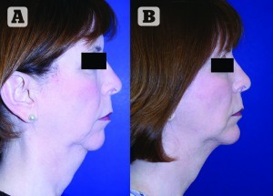 Figure 12 (A) Preoperative and (B) postoperative images of a patient with microgenia who underwent prejowl chin augmentation with submentoplasty