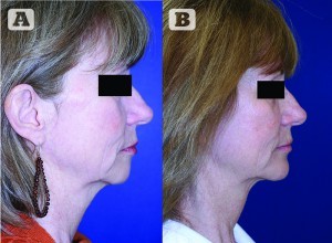 Figure 13 (A) Preoperative and (B) postoperative images of a patient with microgenia who underwent prejowl chin augmentation with submentoplasty only (no face/neck lift) and lower-lid blepharoplasty