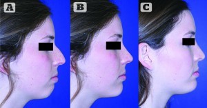 Figure 14 (A) Preoperative image of a patient with microgenia and a dorsal nasal hump, (B) a computer-generated prediction of postoperative results, and (C) a postoperative image of the patient after chin augmentation with rhinoplasty showing how close a result to computer imaging can be achieved. This series of images demonstrates that computer imaging can be a valuable tool in communicating surgical goals with a patient and that the final outcome may often closely approximate the computer‑generated image