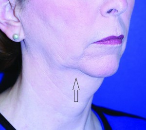 Figure 2 This patient has a hypoplastic mentum with a prejowl sulcus (black arrow) as a result of the ageing process