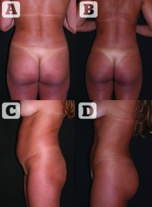 Figure 3 (A) and (B) Preoperative photos of a 40-year-old woman requesting body contouring. (C) and (D) Postoperative photos after gluteal augmentation by stromal enriched lipograft