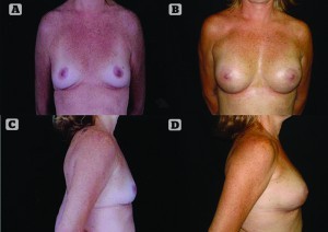 Figure 4 (A) and (B) Preoperative photos of a 32-year-old woman requesting breast augmentation, and (C) and (D) postoperative photos after breast augmentation by stromal enriched lipograft 