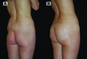 Figure 5 (A) Preoperative photos of a 40-year-old woman requesting gluteal correction after trauma, and (B) postoperative photos after gluteal augmentation by stromal enriched lipograft
