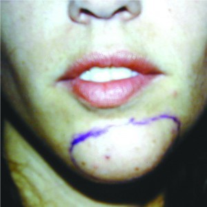 Figure 6 Central chin implants frequently migrate, as shown in this patient. The chin implant position has been outlined