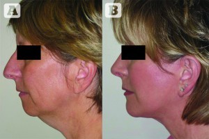 Figure 9 (A) Preoperative and  (B) postoperative images of a patient with microgenia and a dorsal nasal hump who underwent prejowl chin augmentation, rhinoplasty, and a rhytidectomy