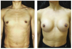 Figure 1 A young woman wished to undergo breast augmentation to give her chest a more feminine appearance. She selected silicone implants to be placed in a subpectoral pocket; (A) before, and (B) 2 months after surgery 