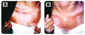 Figure 1 18 year old female who suffered from vitiligo for 3 years (A) before and (B) after 15 weeks of treatment