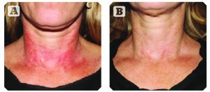 Poikiloderma (A) before and (B) after one treatment (Images © Joely Kaufman, MD)