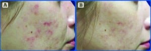 Figure 1 (A) Before treatment and (B) 20 days after one treatment with the Eclipse MicroPen. (Courtesy of Jody Comstock, MD)
