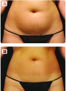 Figure 1  (A) Before and (B) after six VelaShape treatments.