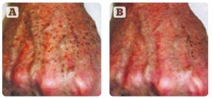 Figure 2 (A) Before treatment, and (B) after treatment with the Tri-Lase system for the 