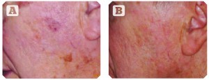 PIgmented and vascular lesions (A) before and (B) after two treatments (Images © David Vasily, MD)
