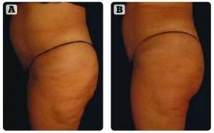 Figure 2 (A) Before and (B) after three combination cellulite and body contouring treatments