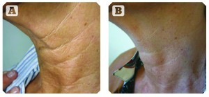 Patient B, aged 53 years. (A) Before and (B) 4 months post-treatment