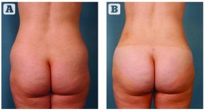 (A) Before and (B) after VASERlipo to the abdomen, flanks and inner thighs, with fat grafts to the buttocks and hips. (Images courtesy of Mark D. Epstein, M.D., F.A.C.S.)