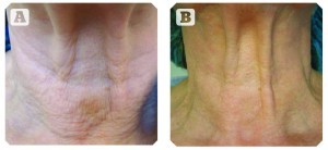Patient C, aged 72 years. (A) Before and (B) 4 months post-treatments